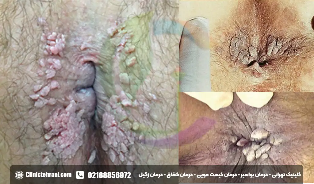 عکس گوشت اضافه مقعدی
