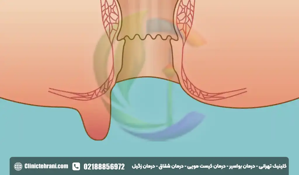 گوشت اضافی مقعدی