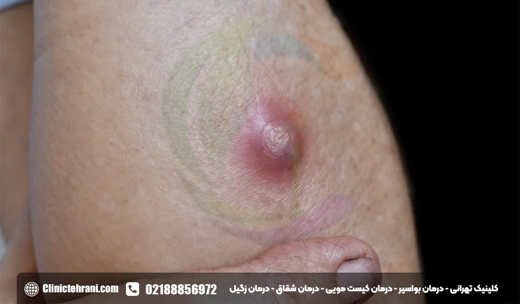 نحوه تشخیص دقیق کیست مویی