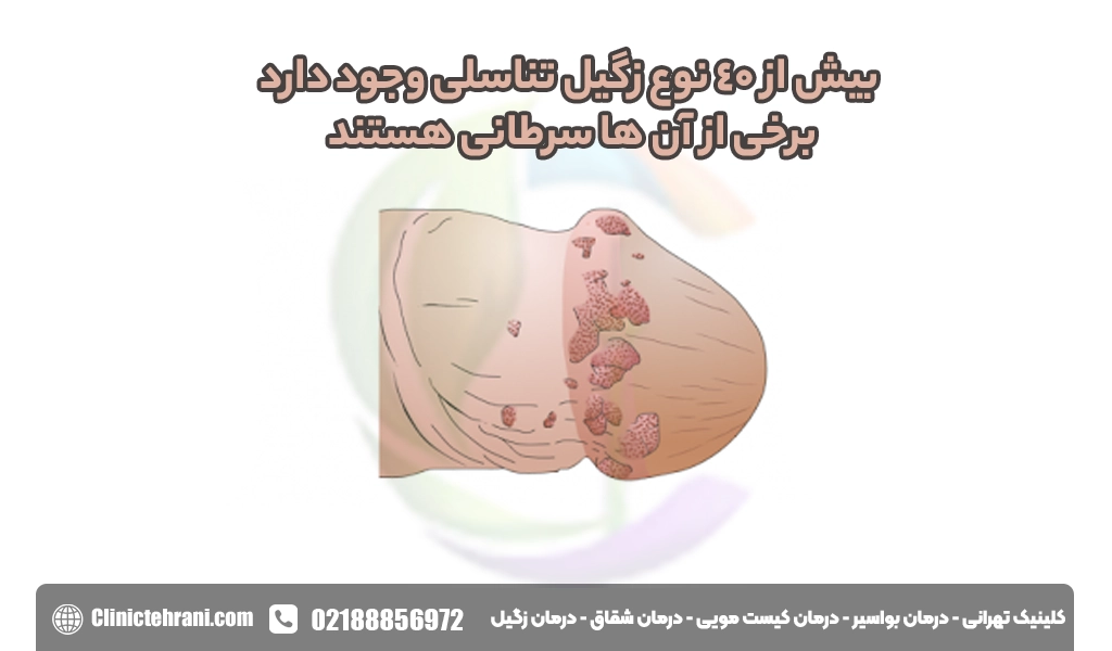 انواع زگیل تناسلی