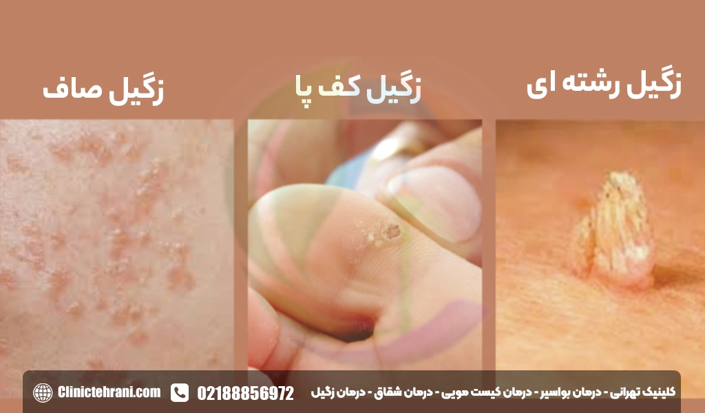 انواع زگیل پوستی