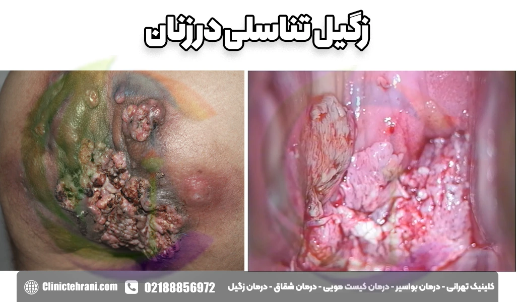 زگیل تناسلی در زنان
