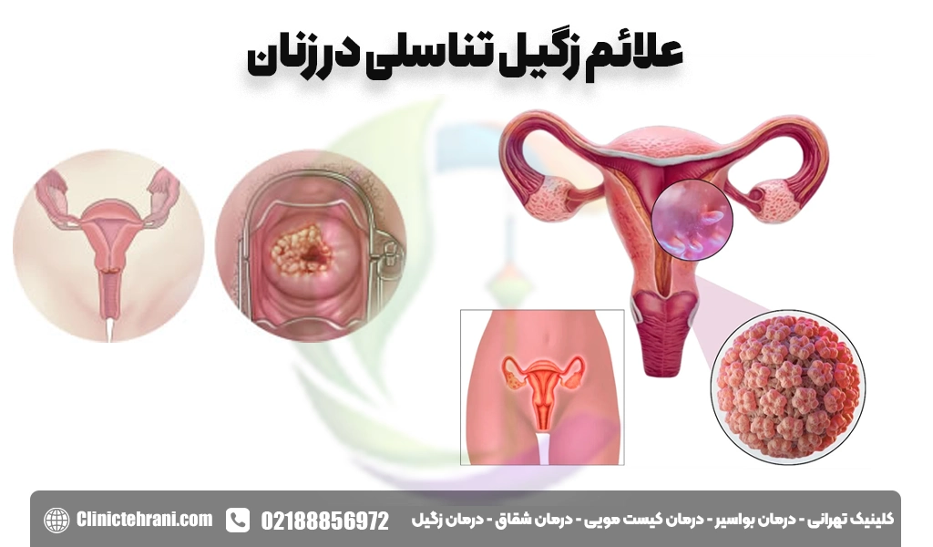 علائم زگیل تناسلی در زنان