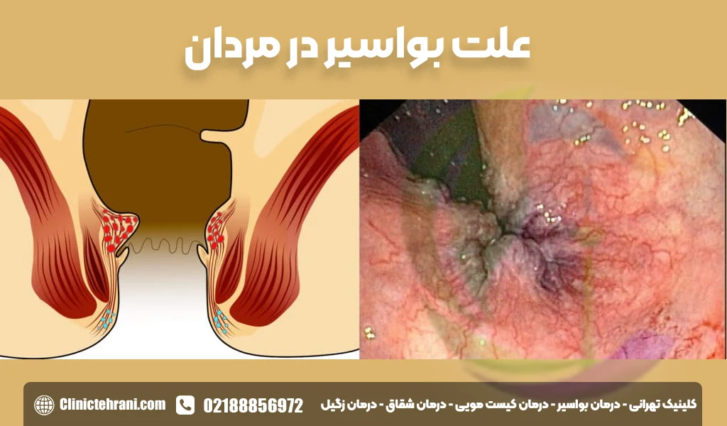 علت بواسیر در مردان