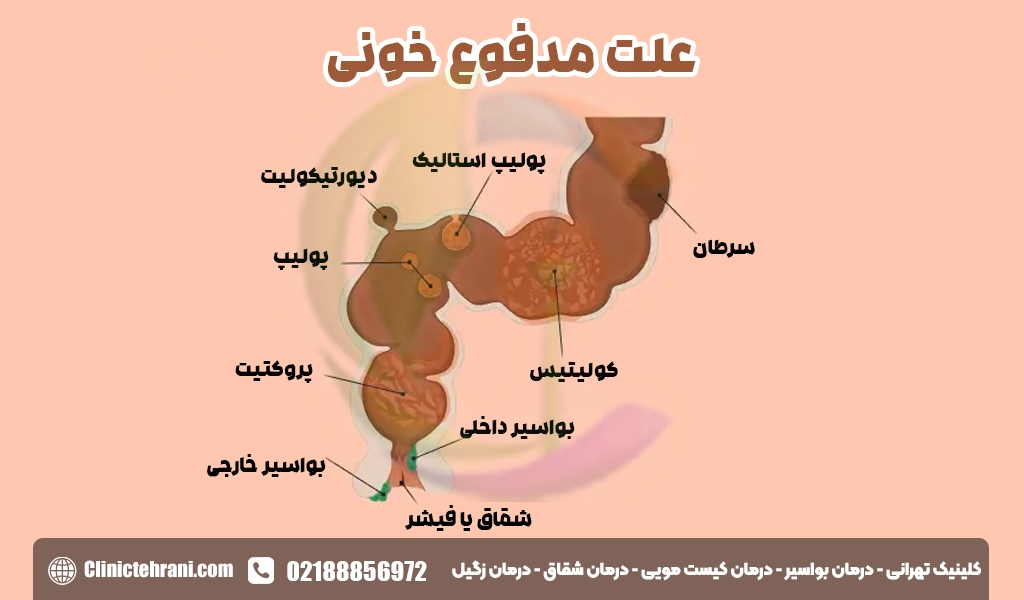 علت مدفوع خونی