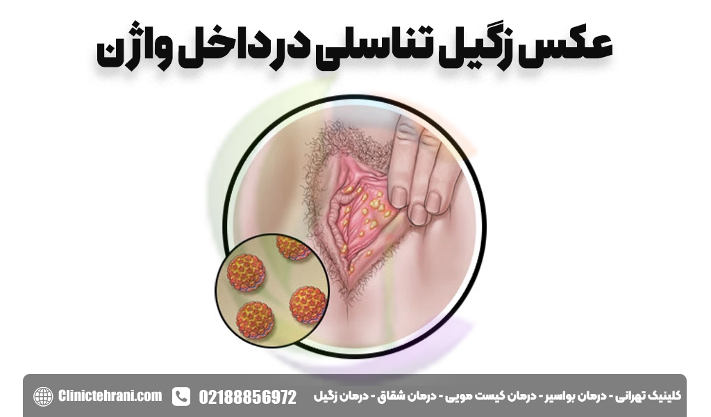 عکس زگیل تناسلی داخل واژن