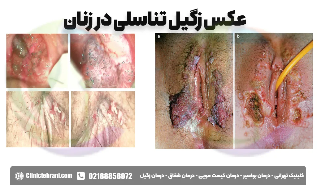 عکس زگیل تناسلی در زنان