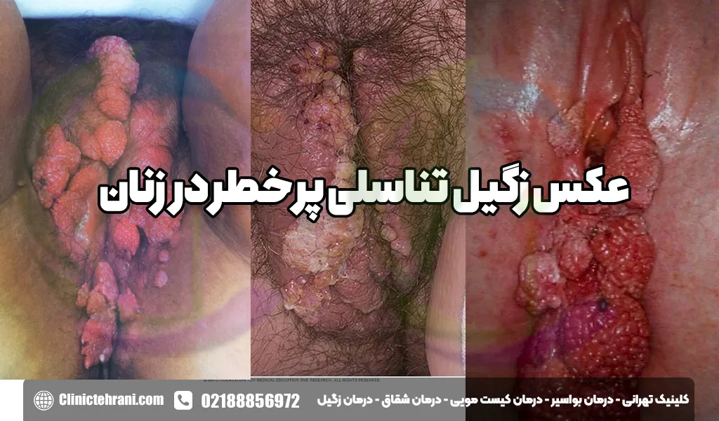 عکس زگیل تناسلی کم خطر در زنان