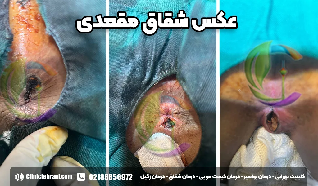 عکس شقاق بیرون زده