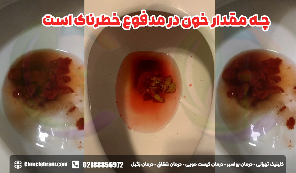 چه مقدار خون در مدفوع خطرناک است