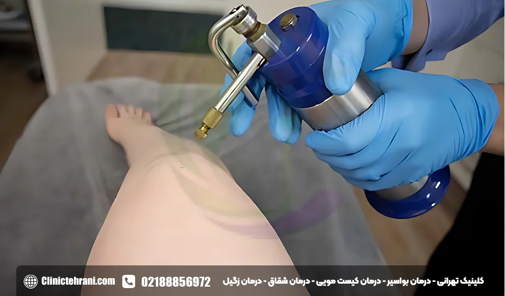 کرایوتراپی زگیل تناسلی HPV چیست