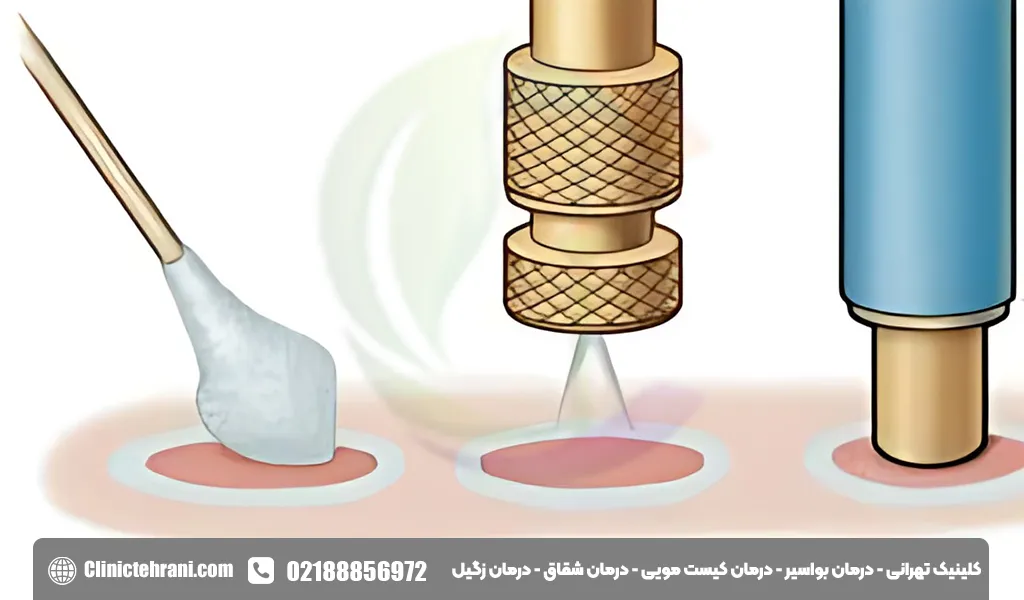 کرایوتراپی زگیل تناسلی