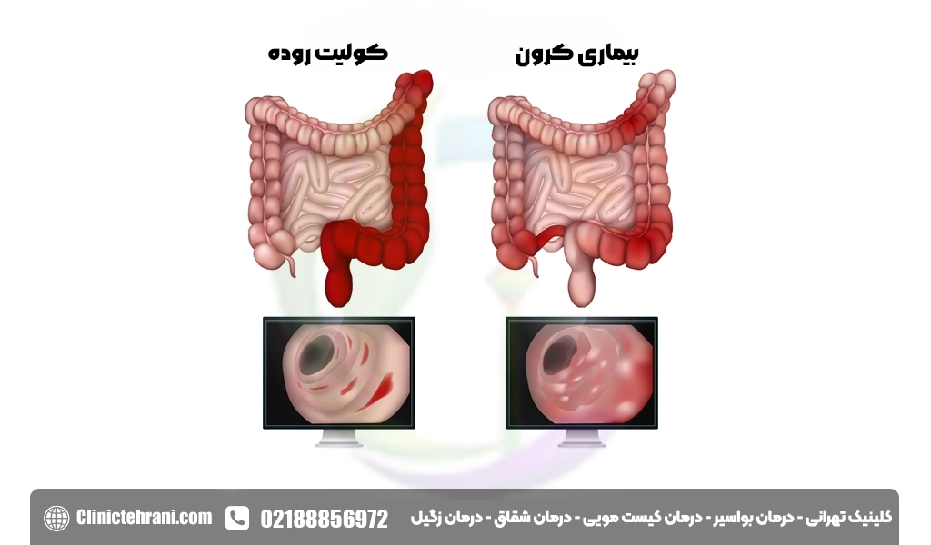 بیماری کرون چیست