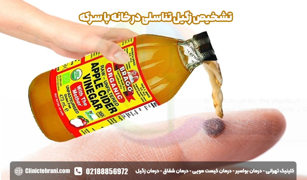 تشخیص زگیل تناسلی در خانه با سرکه