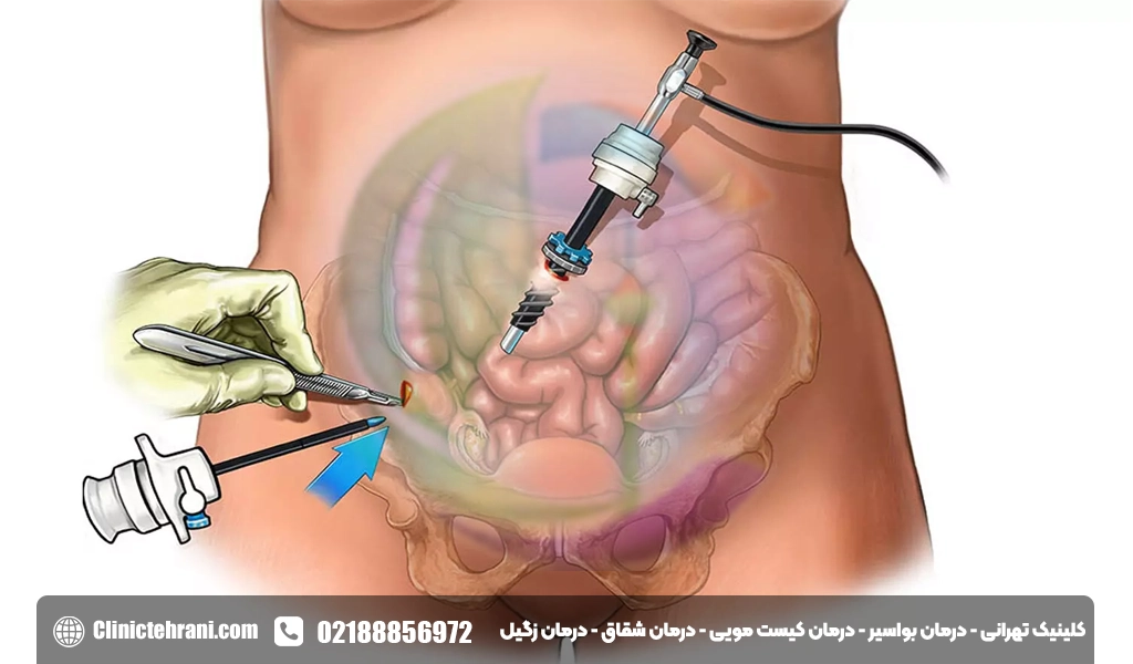 جراحی بیماری کرون