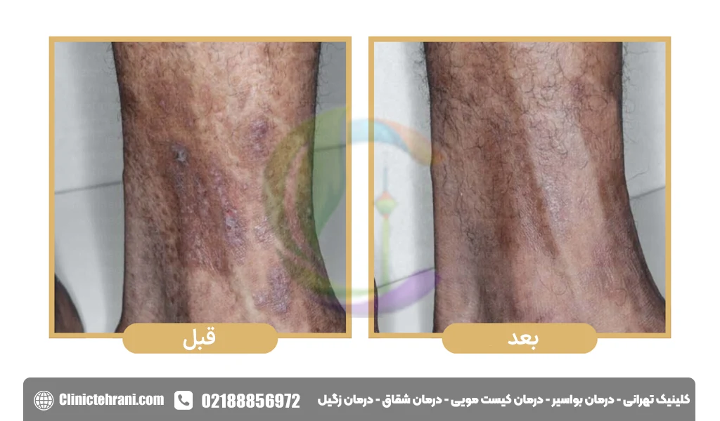 عوارض پماد کلوتریمازول