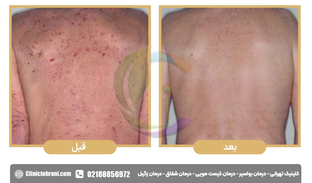 کاربرد های کلوتریمازول