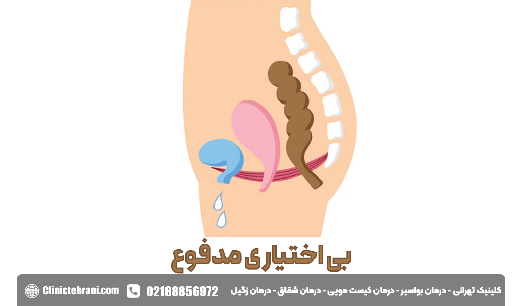 عدم کنترل مدفوع
