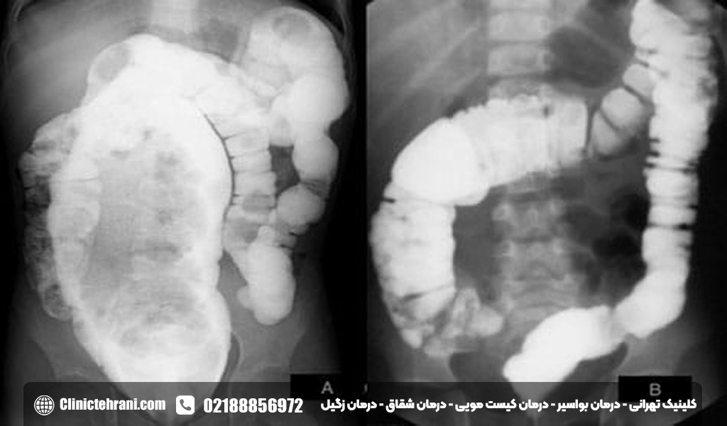 علت بی اختیاری مدفوع در زنان