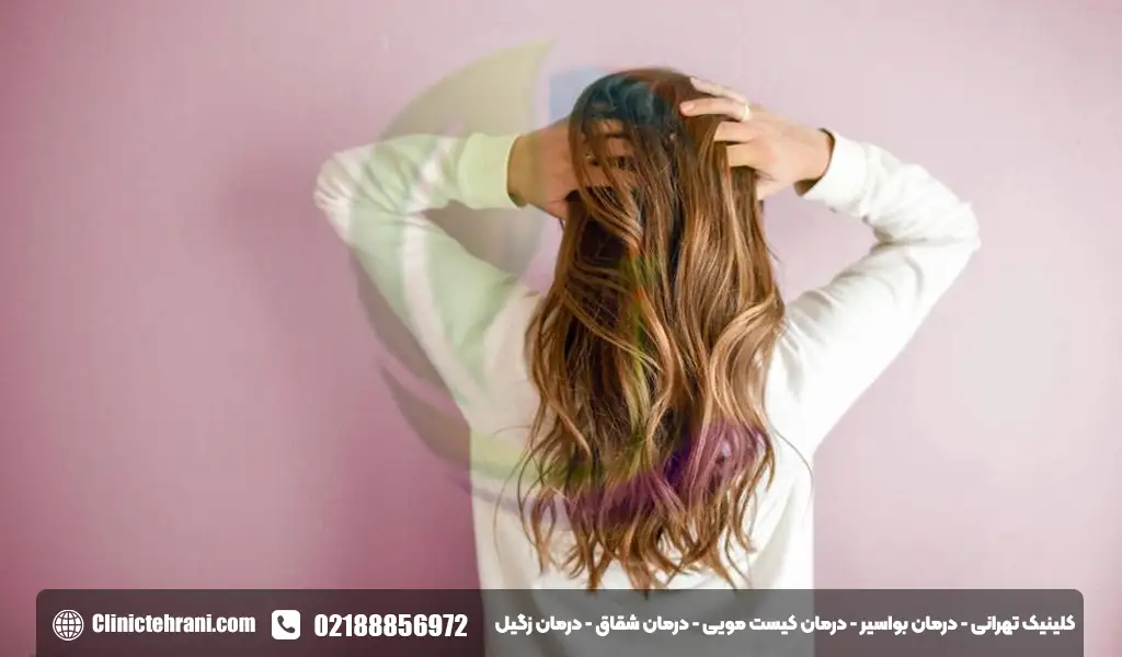 از بین رفتن کیست مویی