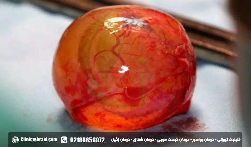 عکس کیست مویی عود کرده