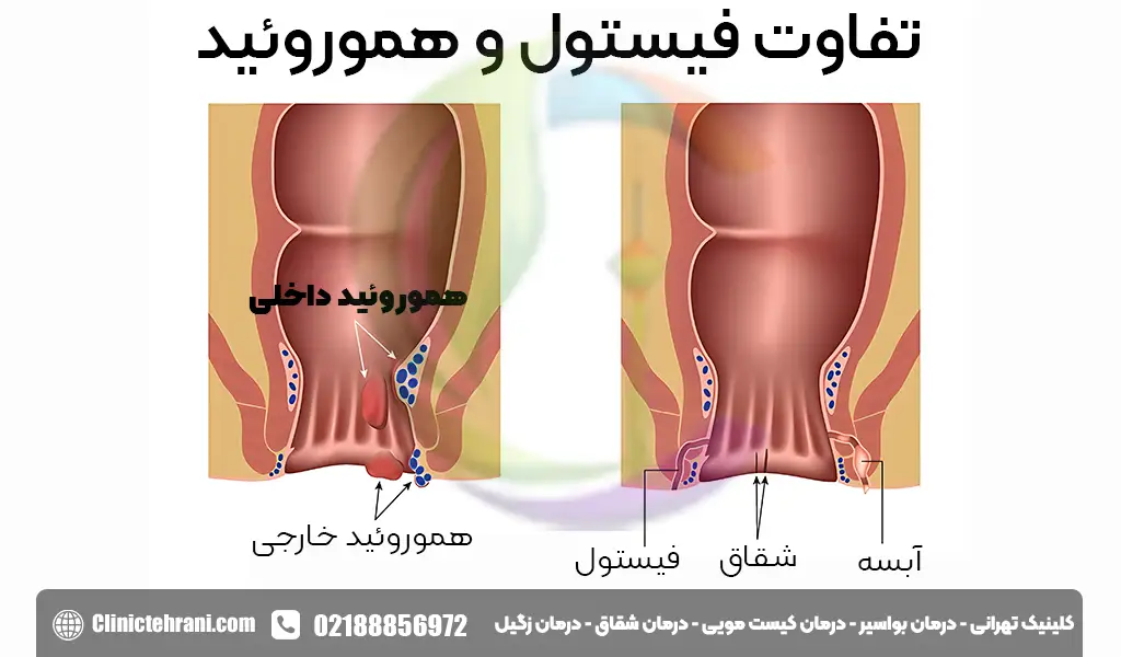 تفاوت فیستول مقعدی و هموروئید