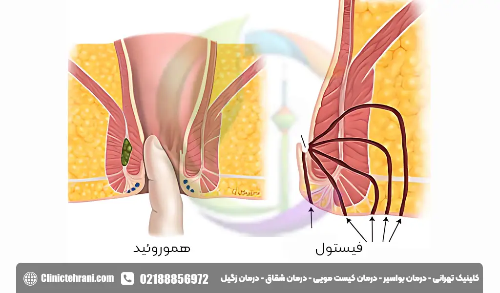 فرق فیستول و بواسیر 