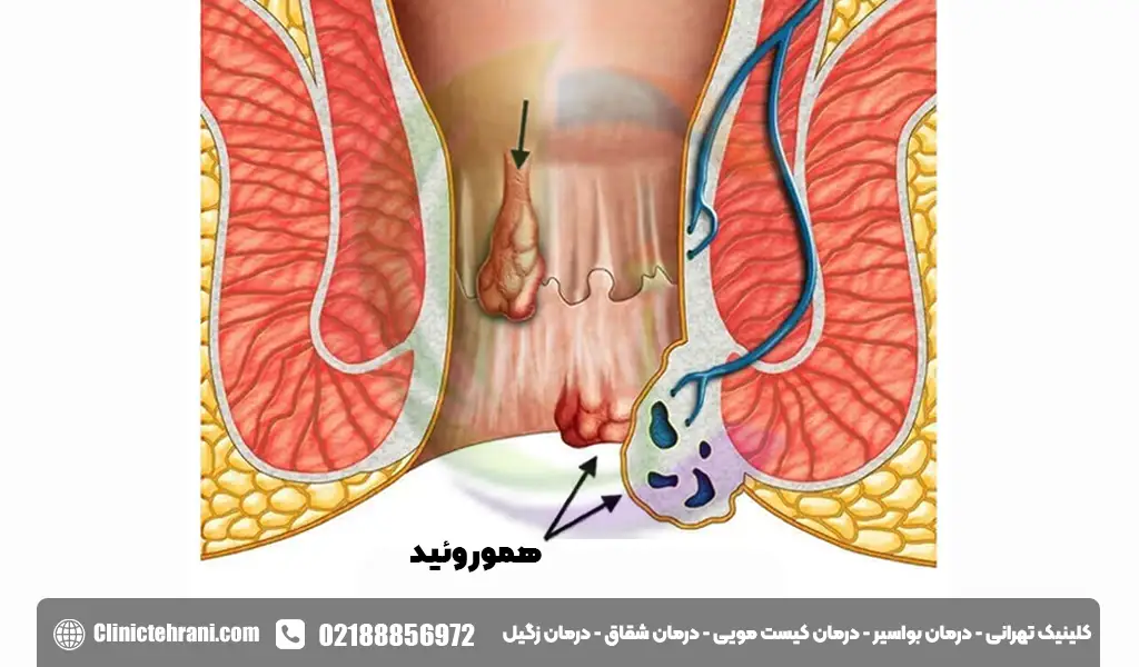 فرق فیستول و هموروئید 