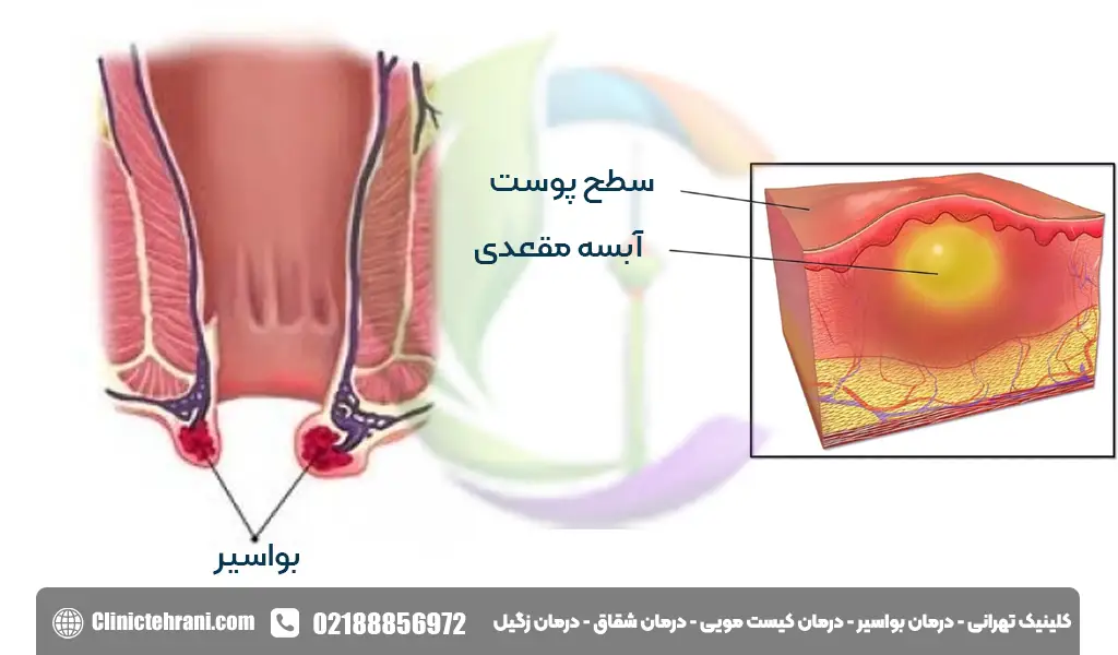 تفاوت آبسه مقعدی و بواسیر