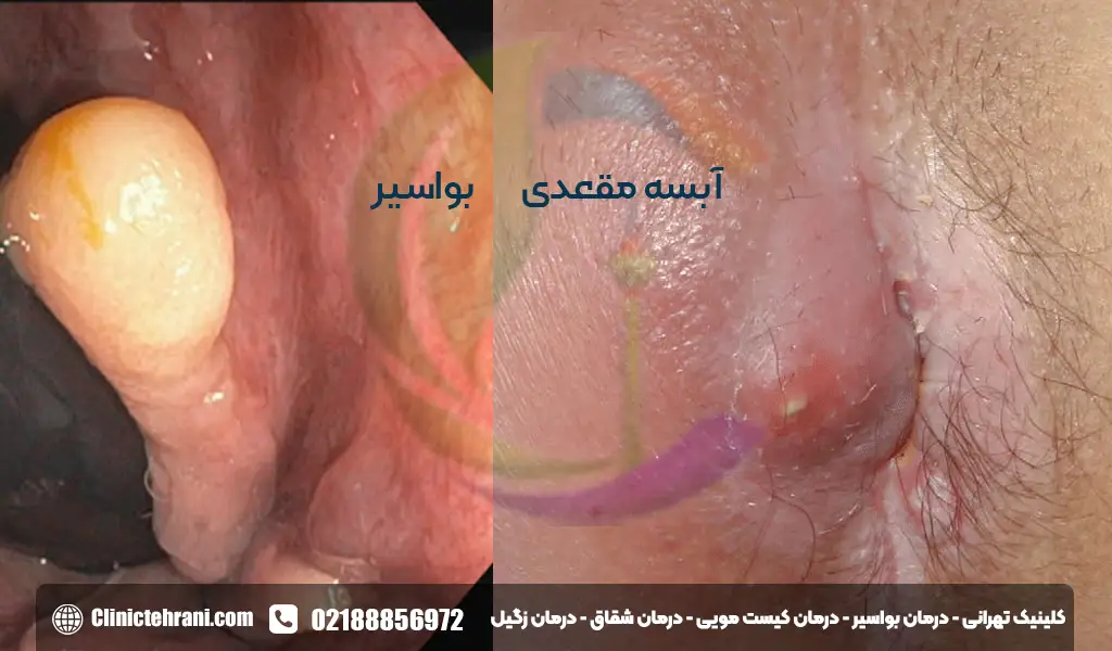 فرق آبسه مقعدی و بواسیر