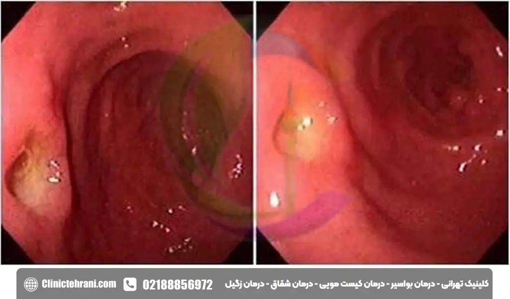 کولیت اولسراتیو