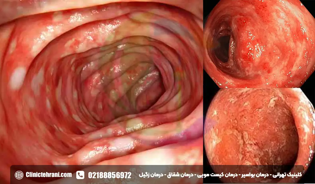 عکس کولیت روده