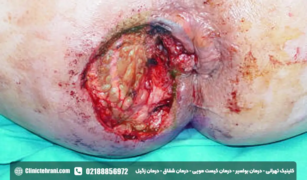 تصاویر سرطان مقعدی