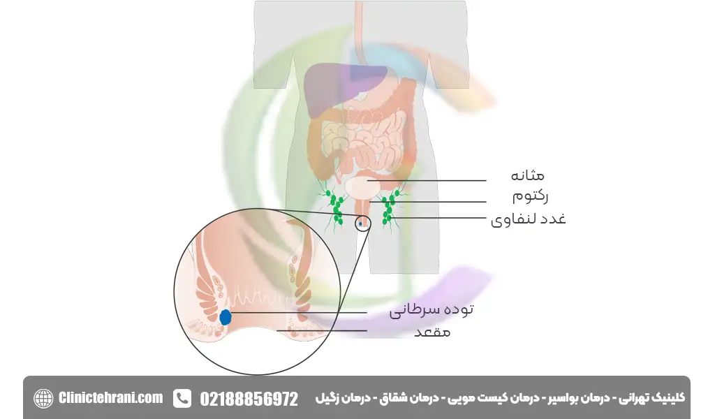 تفاوت هموروئید و سرطان مقعد