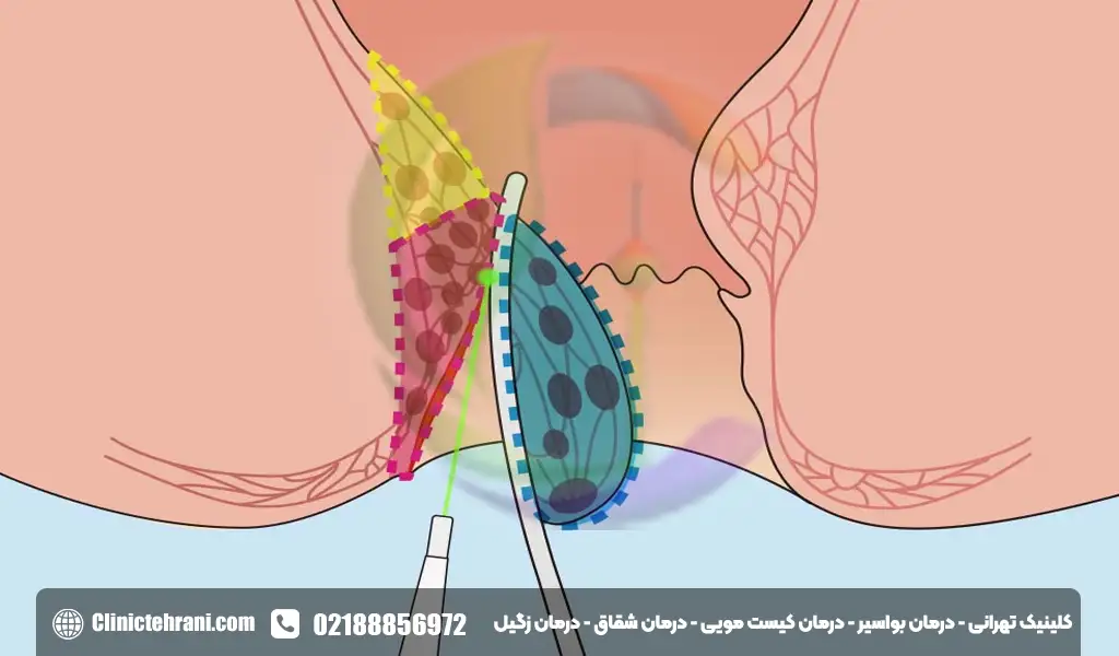 روش های جدید درمان آبسه مقعد