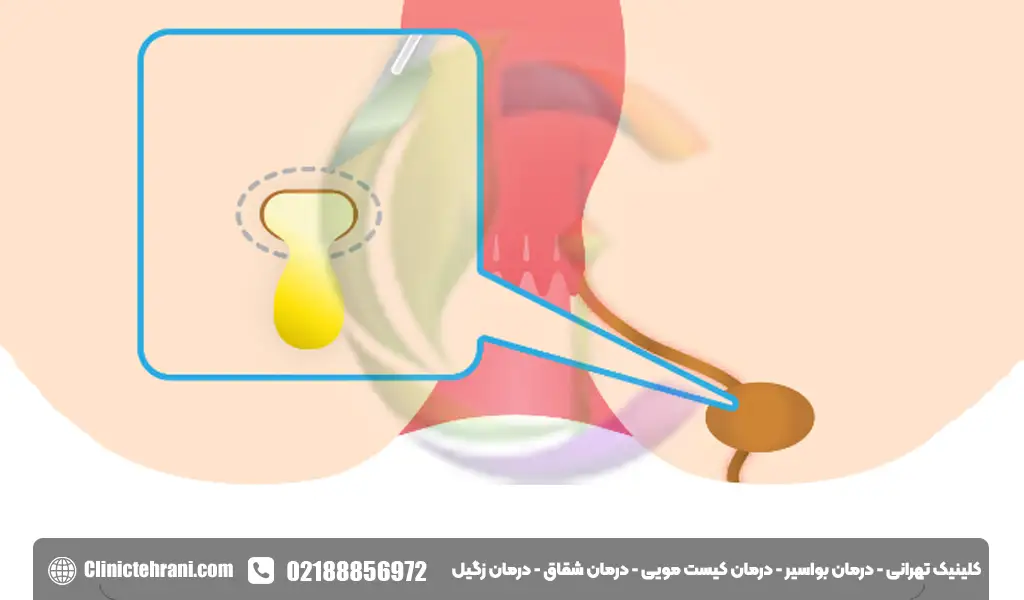 درمان آبسه مقعدی