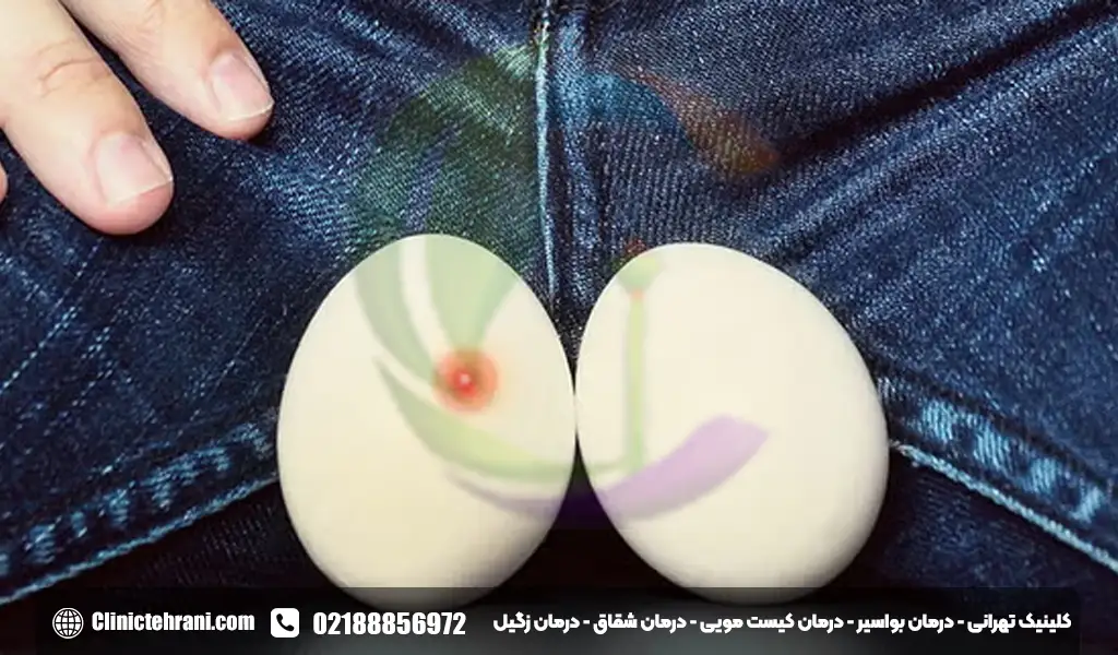 جوش روی بیضه
