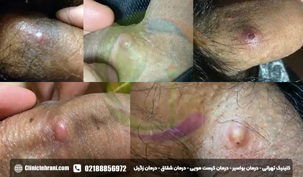 جوش آلت تناسلی