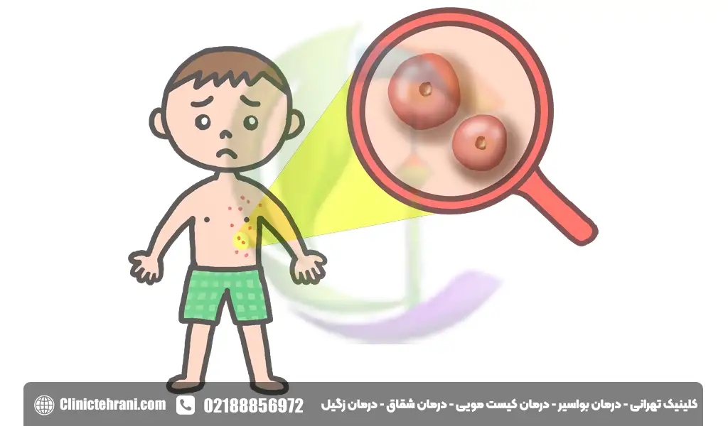 برجستگی جوش مانند در ناحیه تناسلی مردان