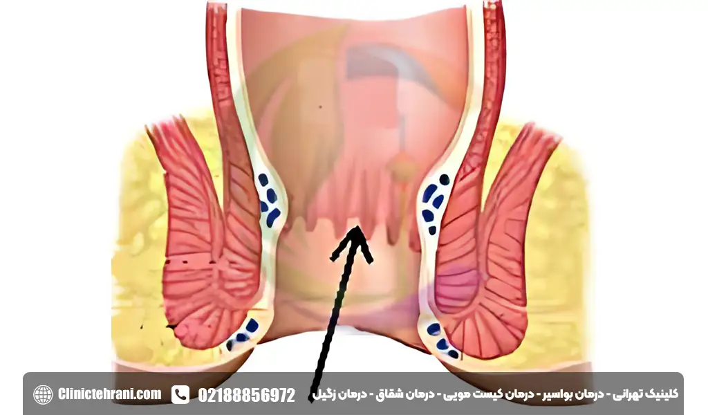 پاپیلای مقعدی چیست؟