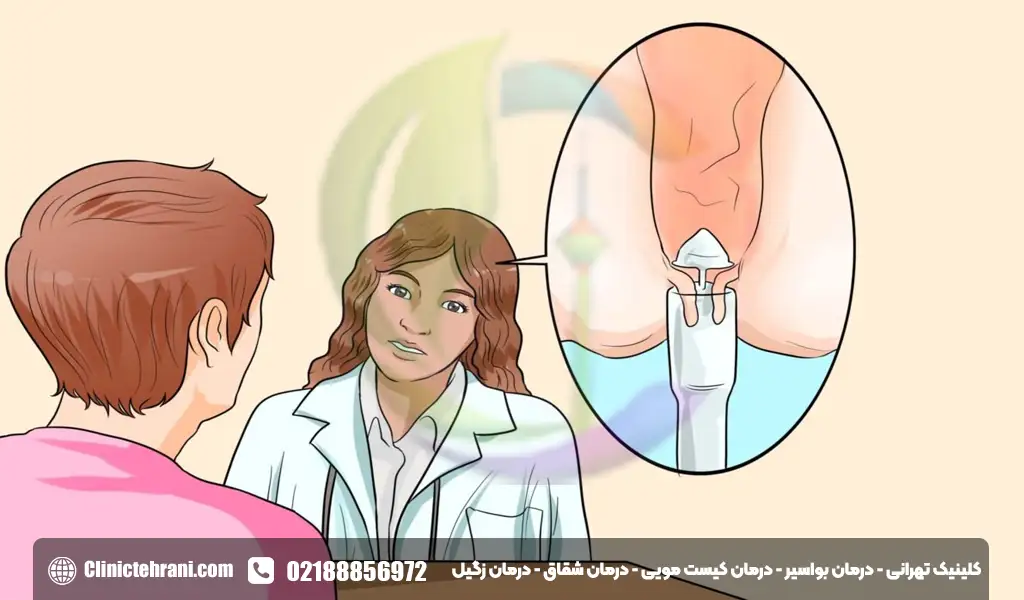 درمان پاپیلای مقعدی هیپرتروفی