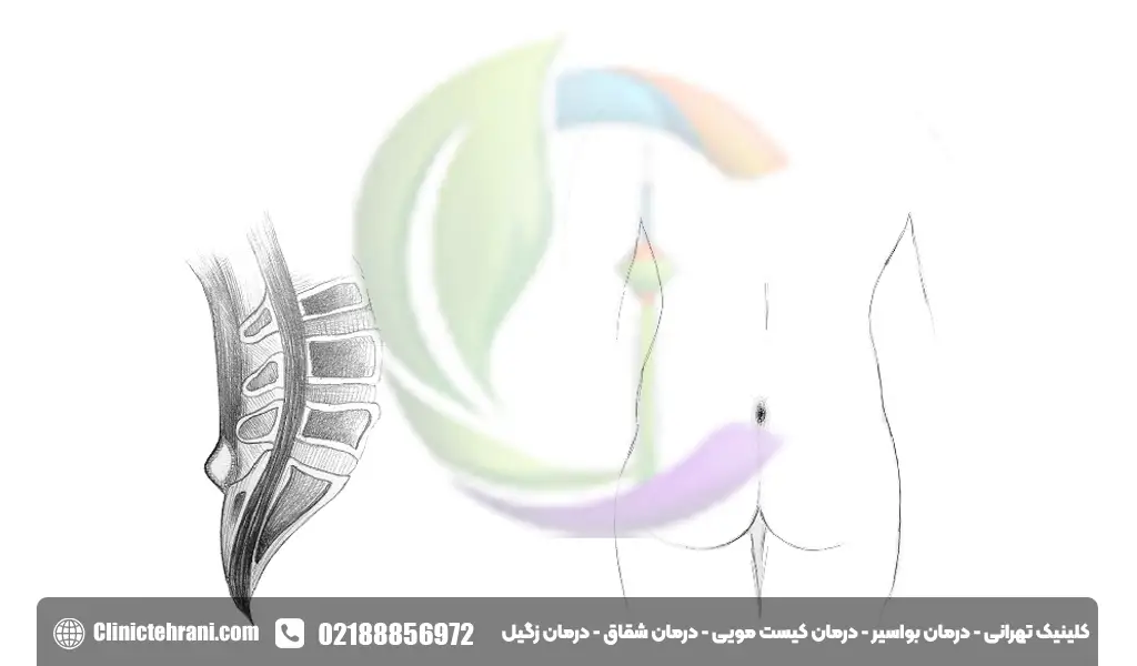 برگشت کیست مویی