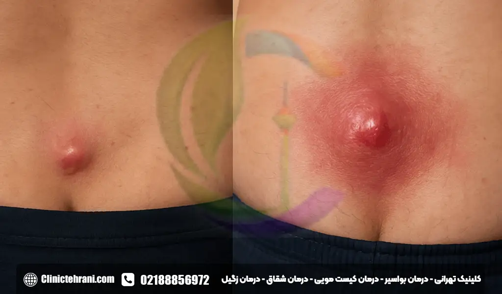 فرق آبسه مقعدی و کیست مویی