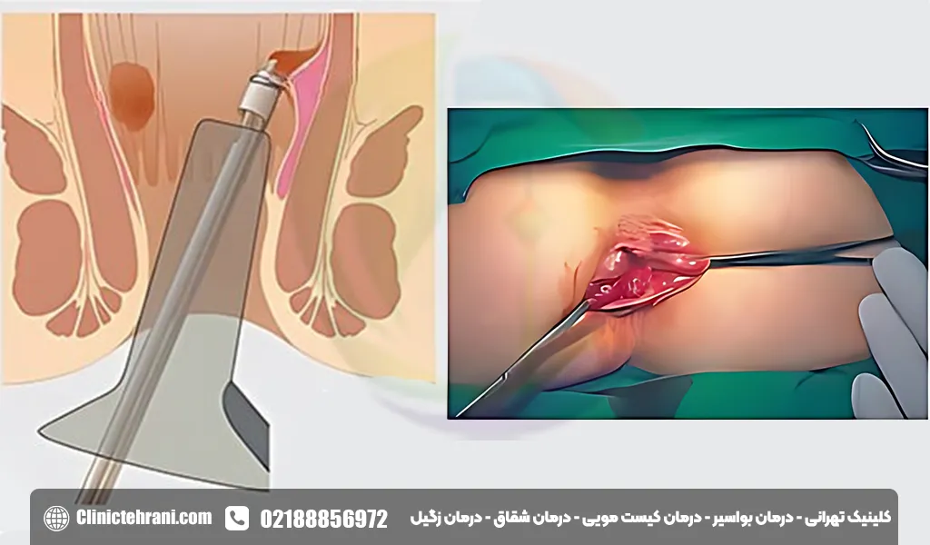 بهترین روش درمان بواسیر