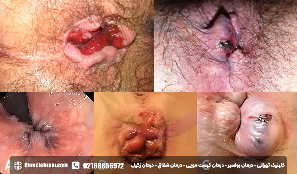 انواع جراحی برای درمان بواسیر 