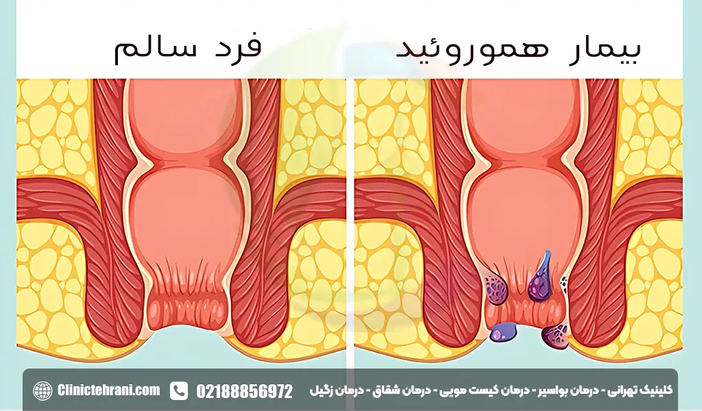 درمان بواسیر در خانه