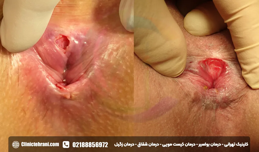 عکس شقاق مقعدی