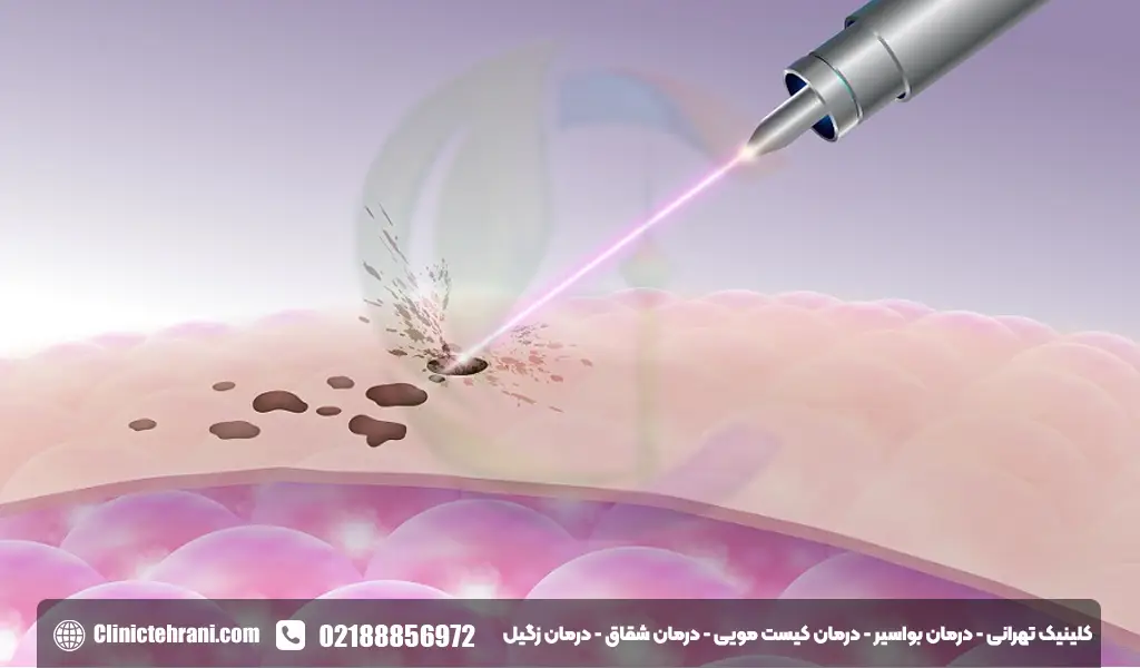 درمان کیست مویی با لیزر