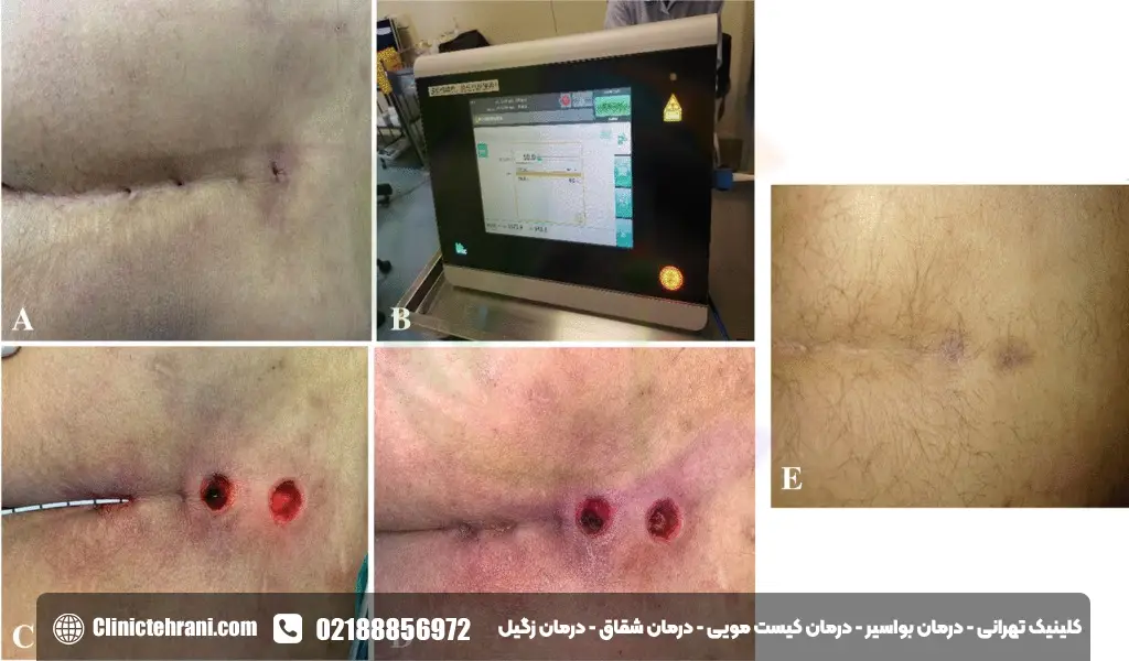 درمان کیست مویی با لیزر