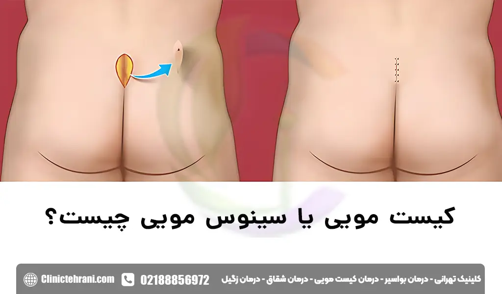 سینوس مویی چیست